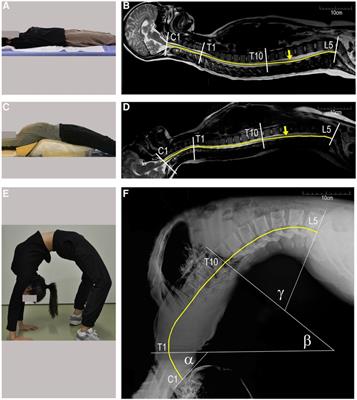 Clinical characteristics and proposed mechanism of pediatric spinal cord injury resulting from backbend practice